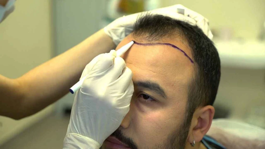 Saç Ekimi - İşaretleme