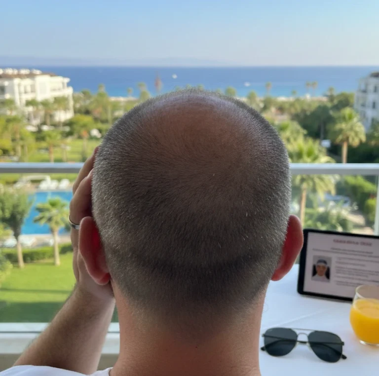 Antalya’da Saç Ekimi: Doğal Sonuçlar ve Modern Klinik Deneyimi