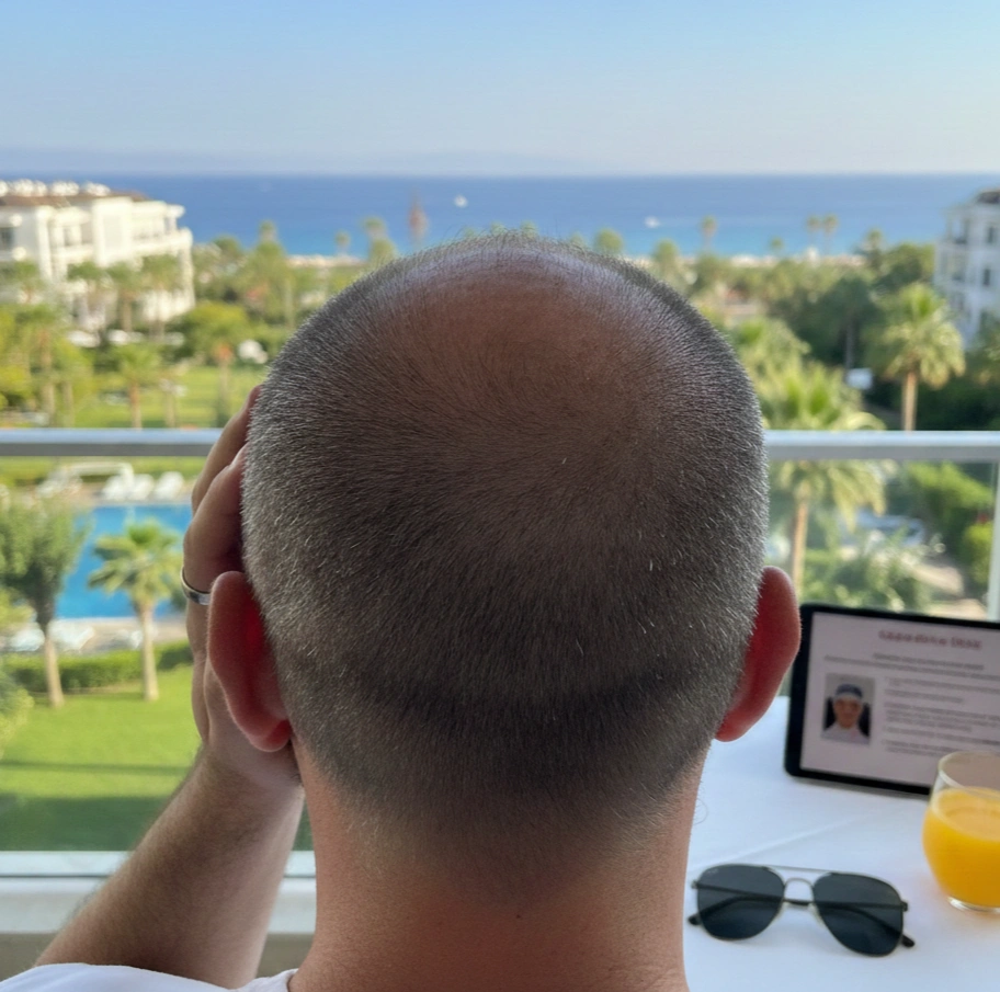 Antalya’da Saç Ekimi: Doğal Sonuçlar ve Modern Klinik Deneyimi